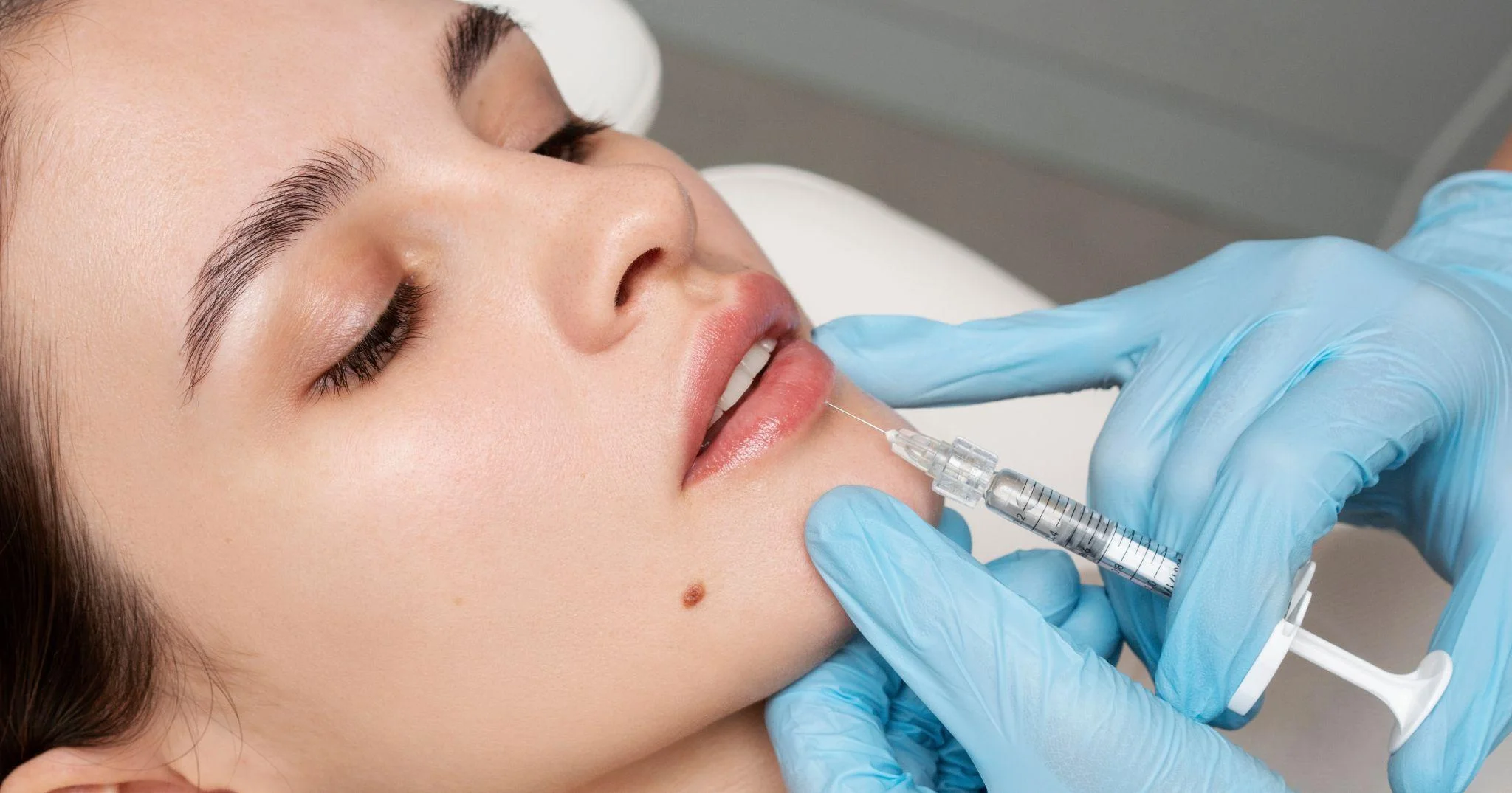Dermal filler treatment being administered near the lips